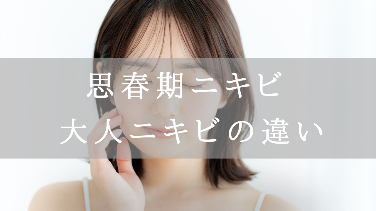 思春期ニキビ違いのアイキャッチ